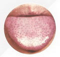 Tongue with red spots